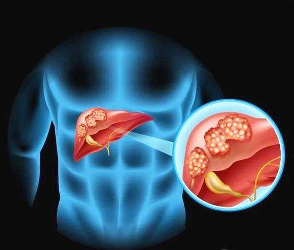 Lenvatinib Mesylate in Liver Cancer Treatment