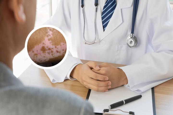 ruxolitinib for vitiligo