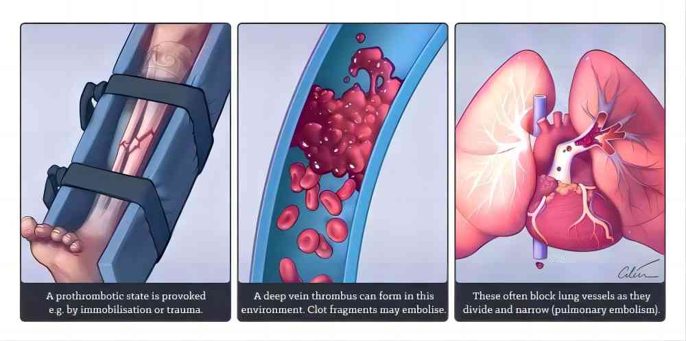 Clinical uses of Dabigatran Etexilate