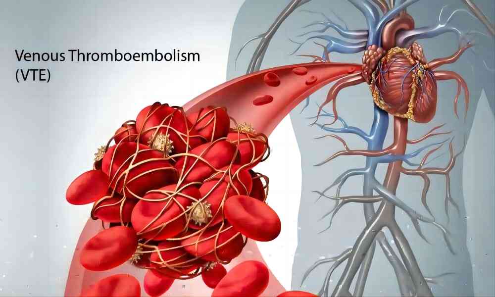 Venous Thromboembolism