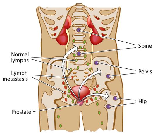 non-metastatic castration-resistant prostate cancer