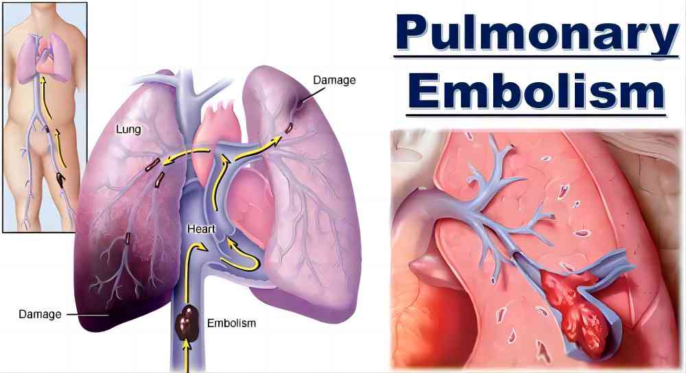 mechanism of dabigatran for pulmonary embolism