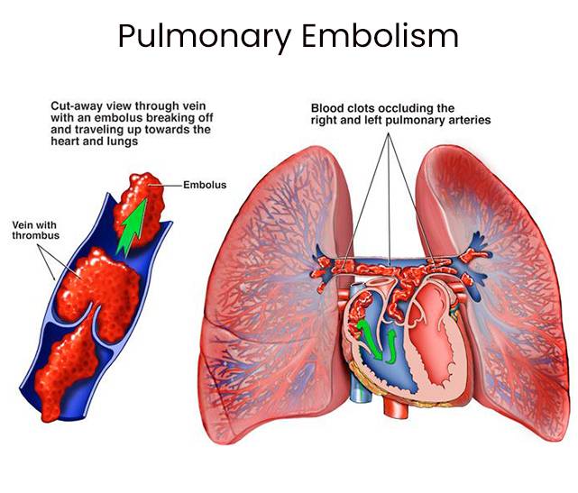 pulmonary embolism